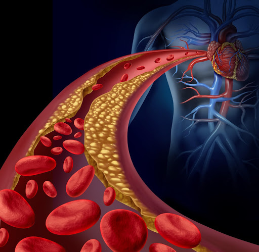 Ketogenic Diet = Cholesterol?