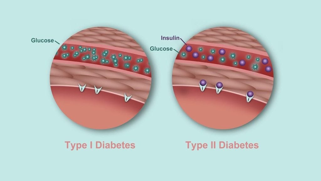 Whats The Difference Between Type 1 And Type 2 Diabetes Rm 1440x810 1